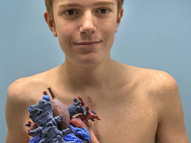 Young boy with scar on chest.